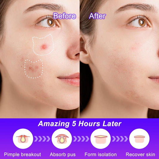 Acne Patches